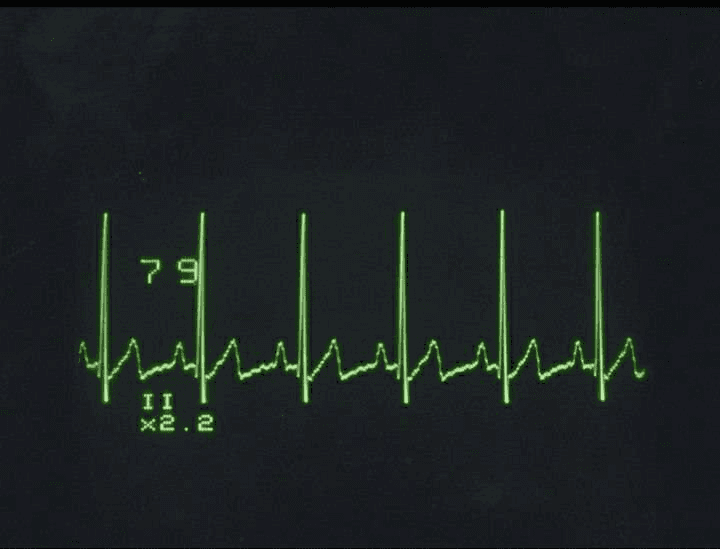 electrocardiogram